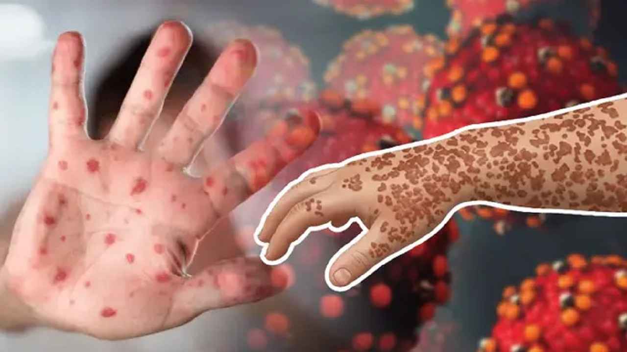 হাম উপসর্গে আরও ৭ জনের মৃত্যু, মোট মৃত্যু ১০১৯